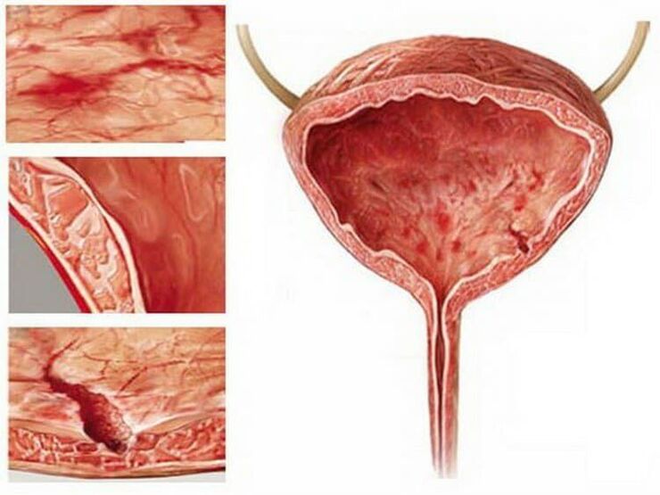 Cystonette es eficaz para todo tipo de cistitis.